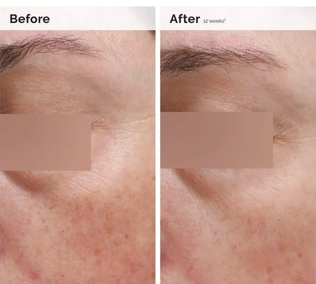 Comparación de piel antes y después de usar la emulsión de niacinamida de Mi tienda para un tono más uniforme.